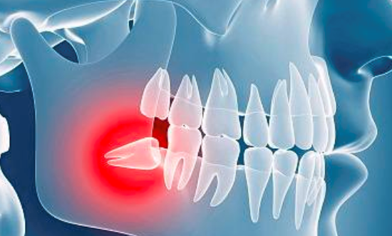 拔智齿的危害