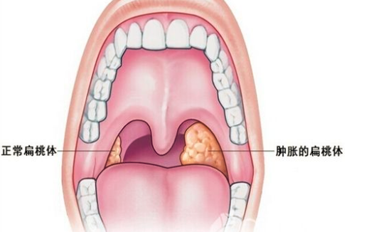 喉咙有异物感怎么办