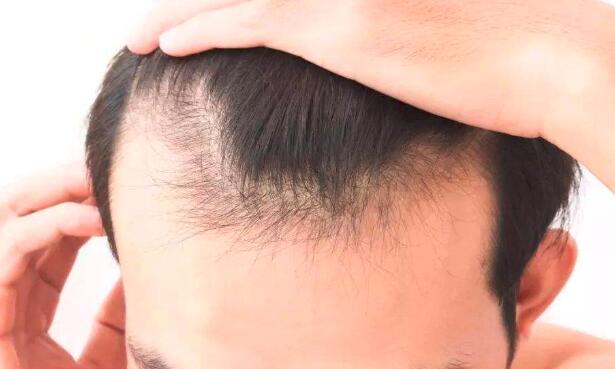 男人吃什么可以防止掉头发