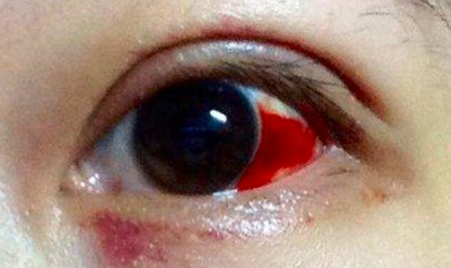 苹果绿 保健常识如果被打眼睛里面有淤血情况,那么就证明有皮下血管