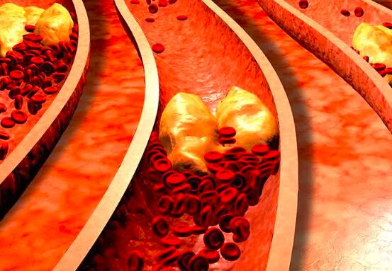 胆固醇高会导致长痘吗