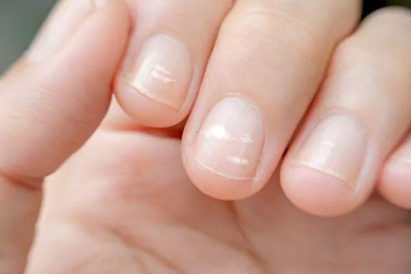 灰指甲早期症状是什么