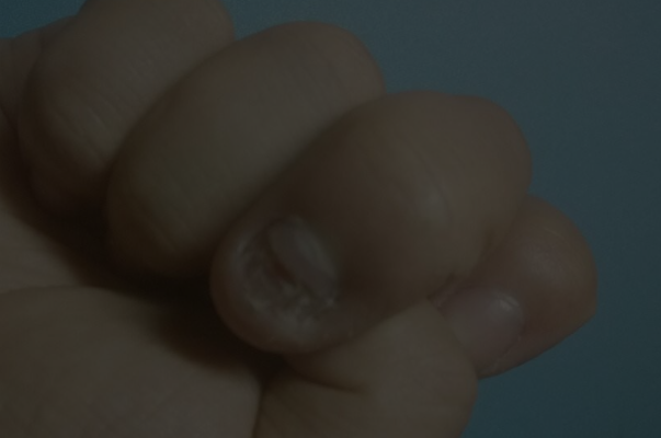 灰指甲的症状图片