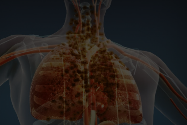 肺癌的早期症状图片